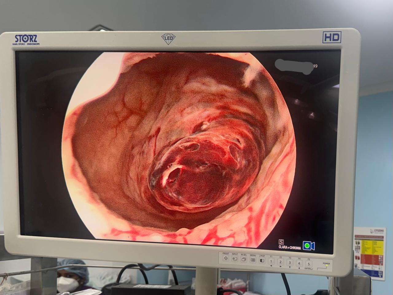 Postmenopausal Bleeding