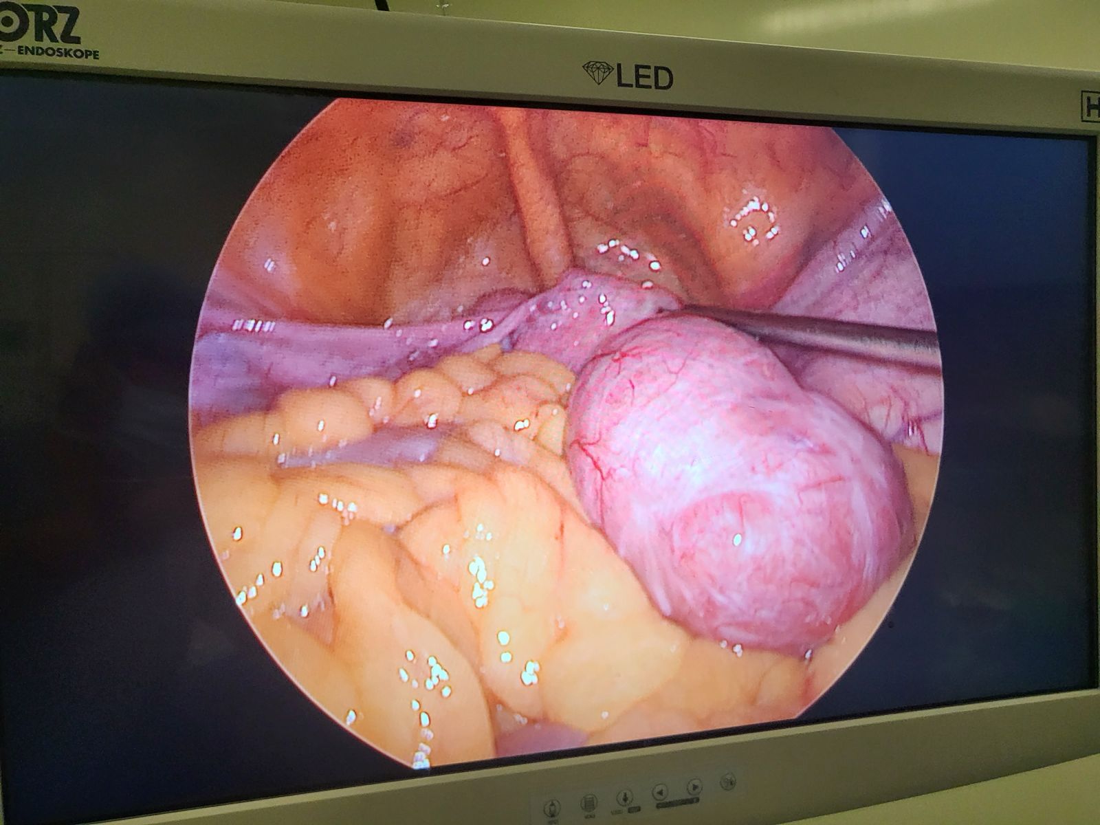 Postmenopausal Bleeding