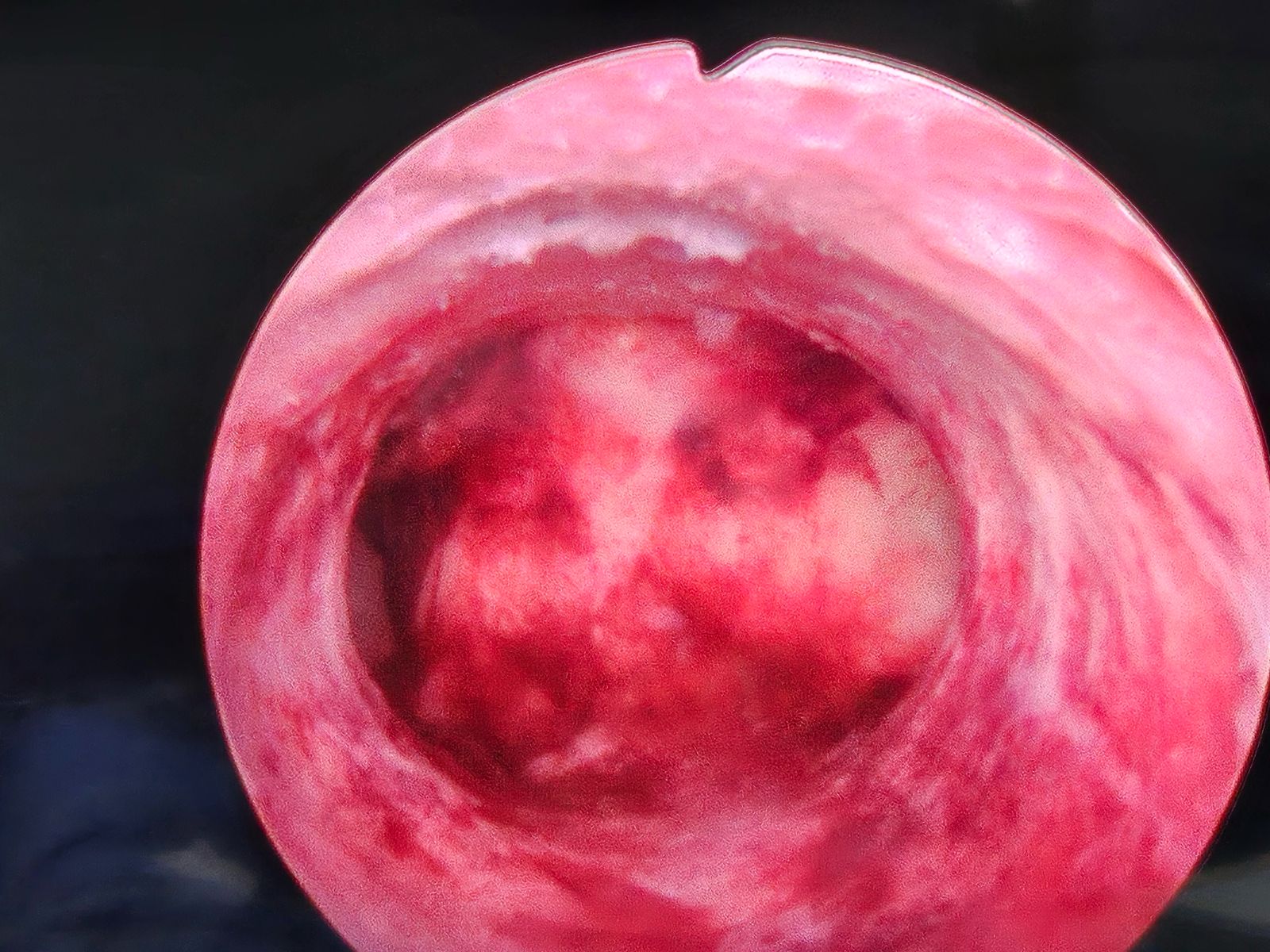 Postmenopausal Bleeding
