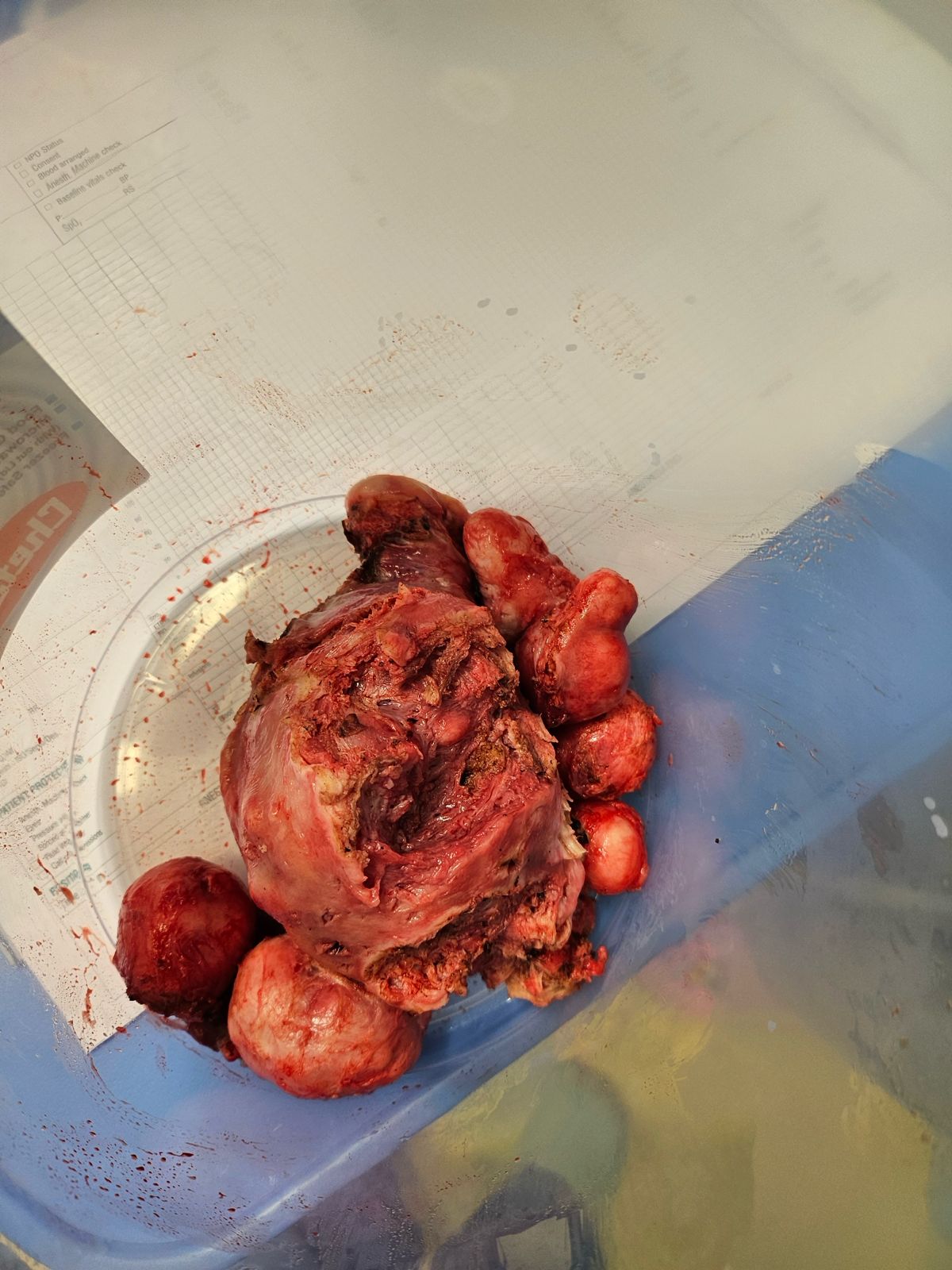 Postmenopausal Bleeding
