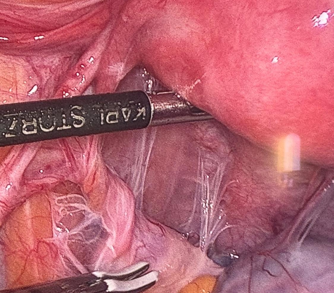 Pic of adhesions mostly following infection in pelvis