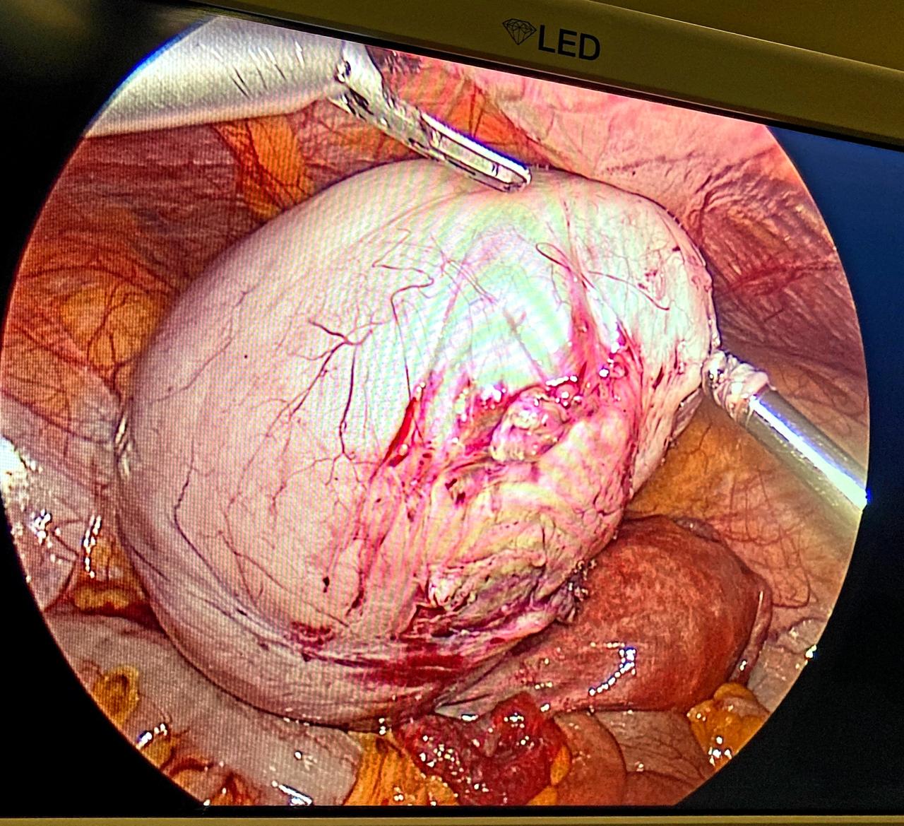 round-ligament-fibroid